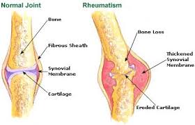 rheumatism