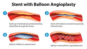 angioplasty